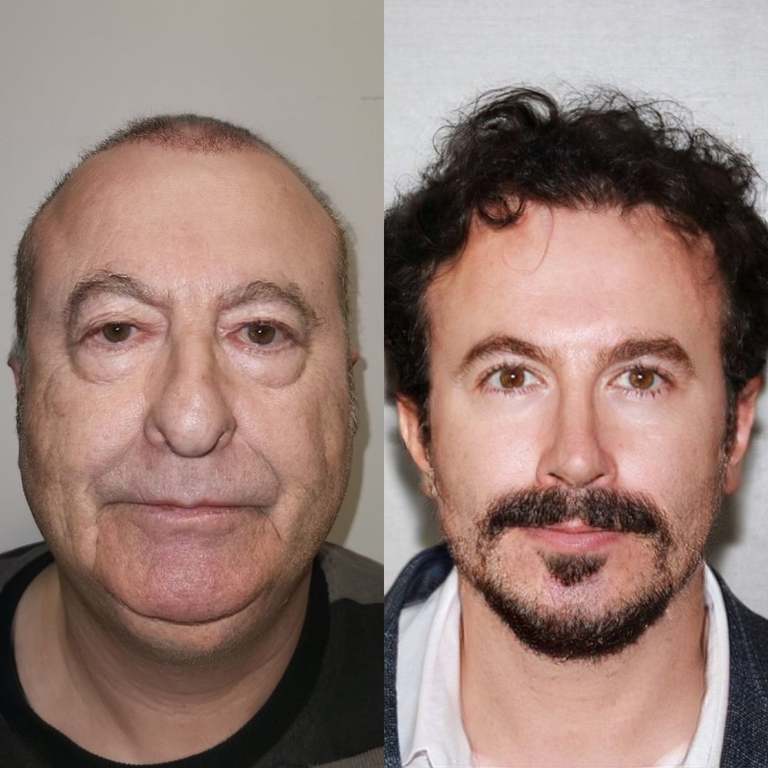Patient Michael's hairline, jaw, nose and skin look completely different after his insane makeover