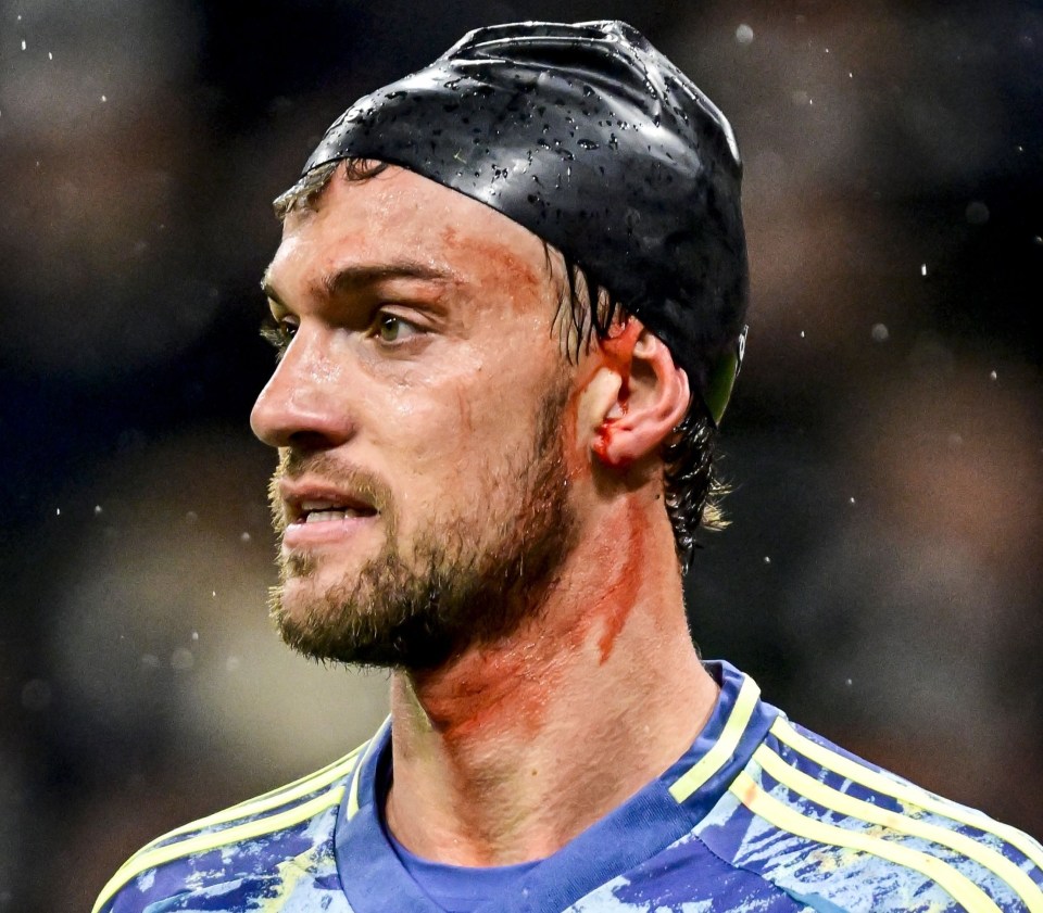 Daniele Rugani of Ajax with a bloody injury.