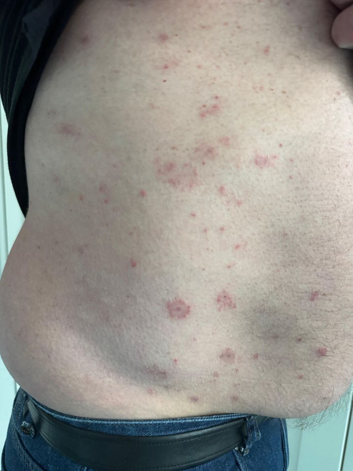 Close-up of skin with multiple reddish lesions.