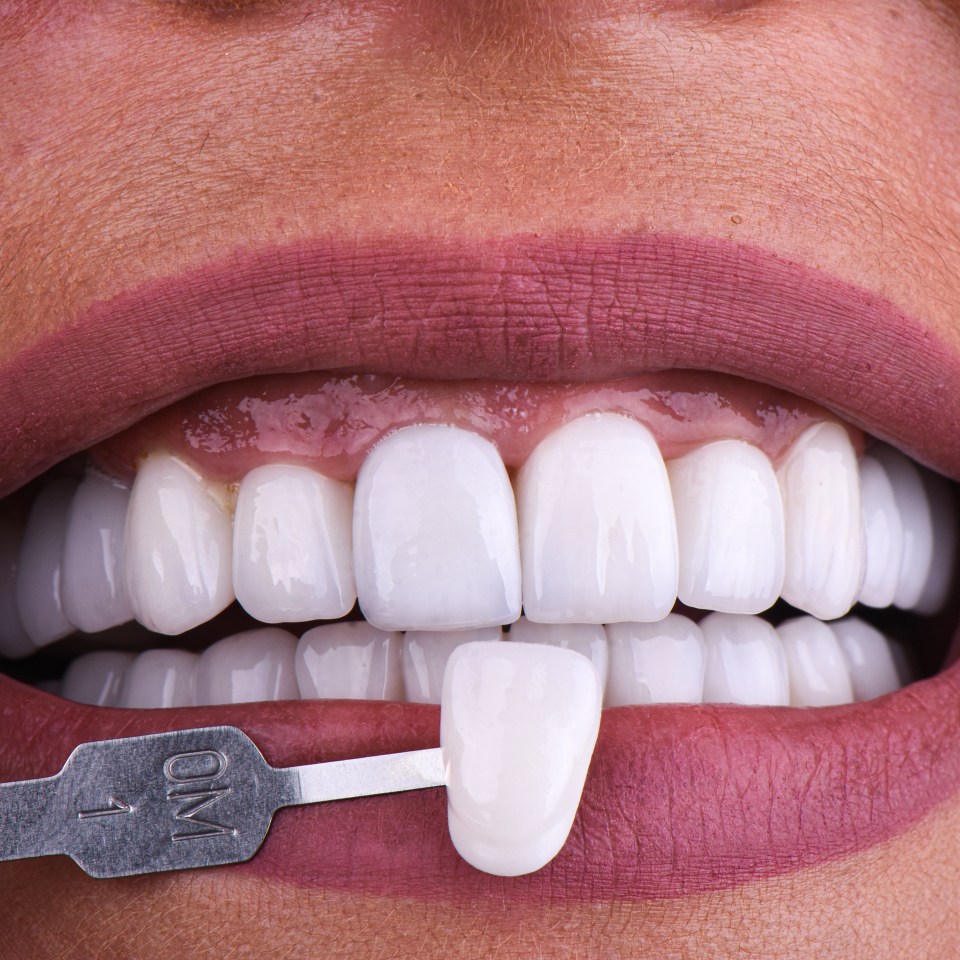 Close-up of a person's teeth with a dental shade guide.