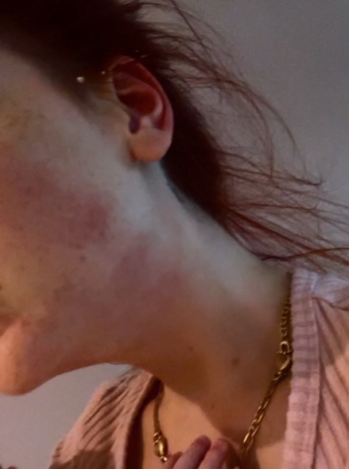 Close-up of a woman's neck showing marks.