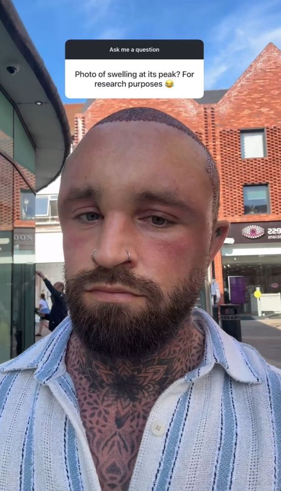 Man with head swelling after hair transplant.