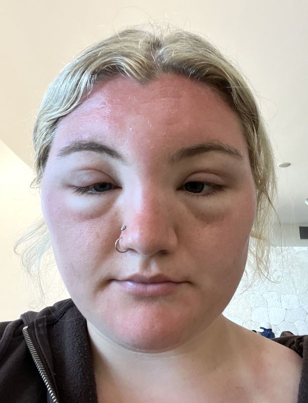 Ashlei's face swollen after being sunburnt, two days into her trip to the Dominican Republic