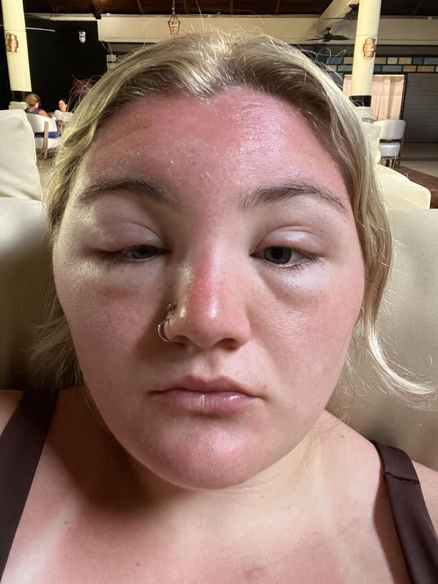 Ashlei was told it was sun poisoning