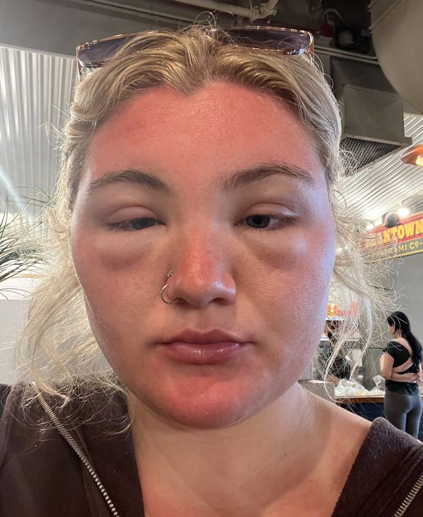 Ashlei needed four days of steroids to reduce the swelling