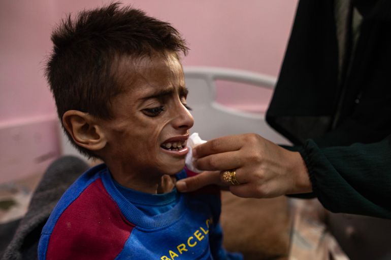 Five year-old Osama al-Raqab, suffering from severe malnutrition, undergoes treatment at the Nasser Hospital in Khan Youni in the southern Gaza Strip 31 May 2025. His mother, Mona al-Raqab says Osama's weight has dropped to just nine kilograms due to his deteriorating health condition caused by ongoing malnutrition. The UN has stated that families are being starved and denied the basic means for survival and only a trickle of aid that falls short of people's massive needs has entered the Gaza Strip after more than 80 days of a total blockade by Israeli authorities. The UN stated that Gaza is the only territory in the world where an entire population is at risk of famine. EPA-EFE/HAITHAM IMAD ATTENTION EDITORS: UPSETTING CONTENT