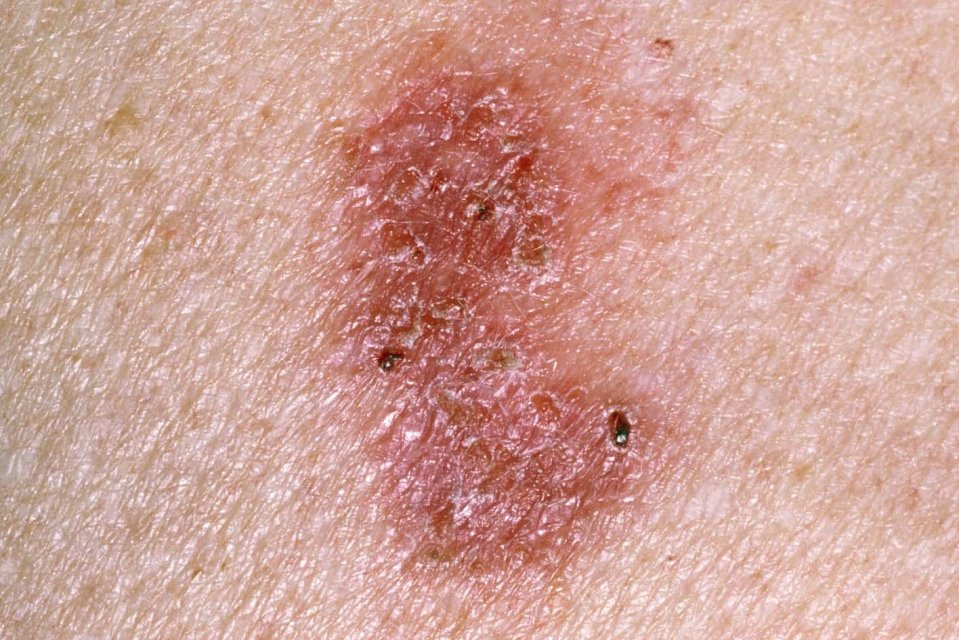 Close-up of non-melanoma skin cancer.