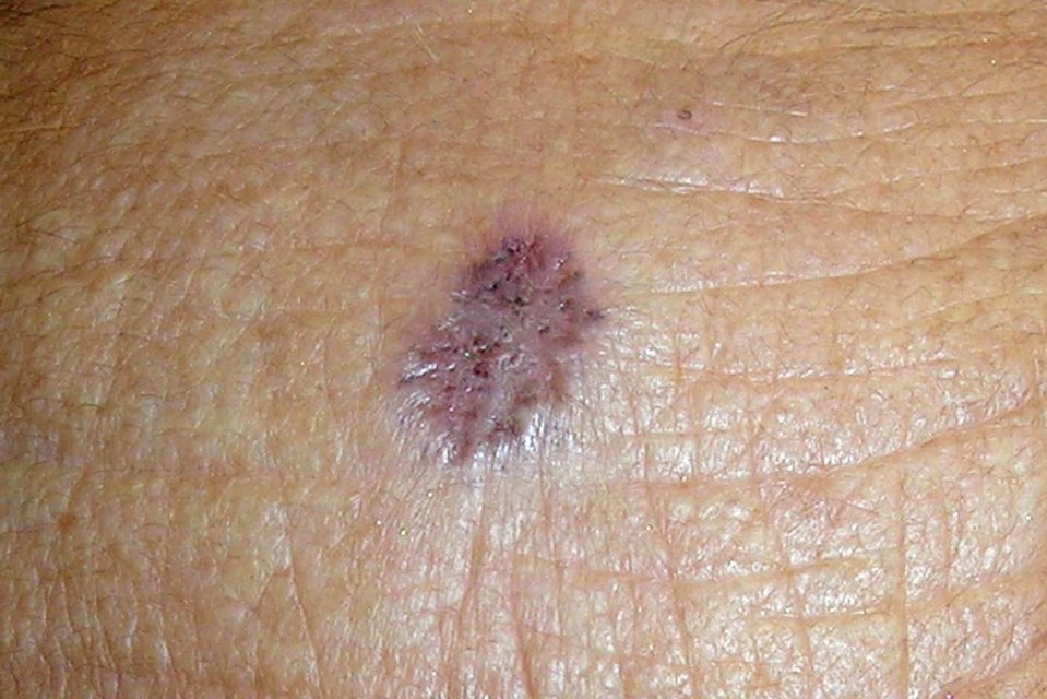 Close-up of a non-melanoma skin cancer lesion.