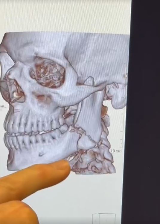 3D render of a human skull and jaw, with a finger pointing to a detail.