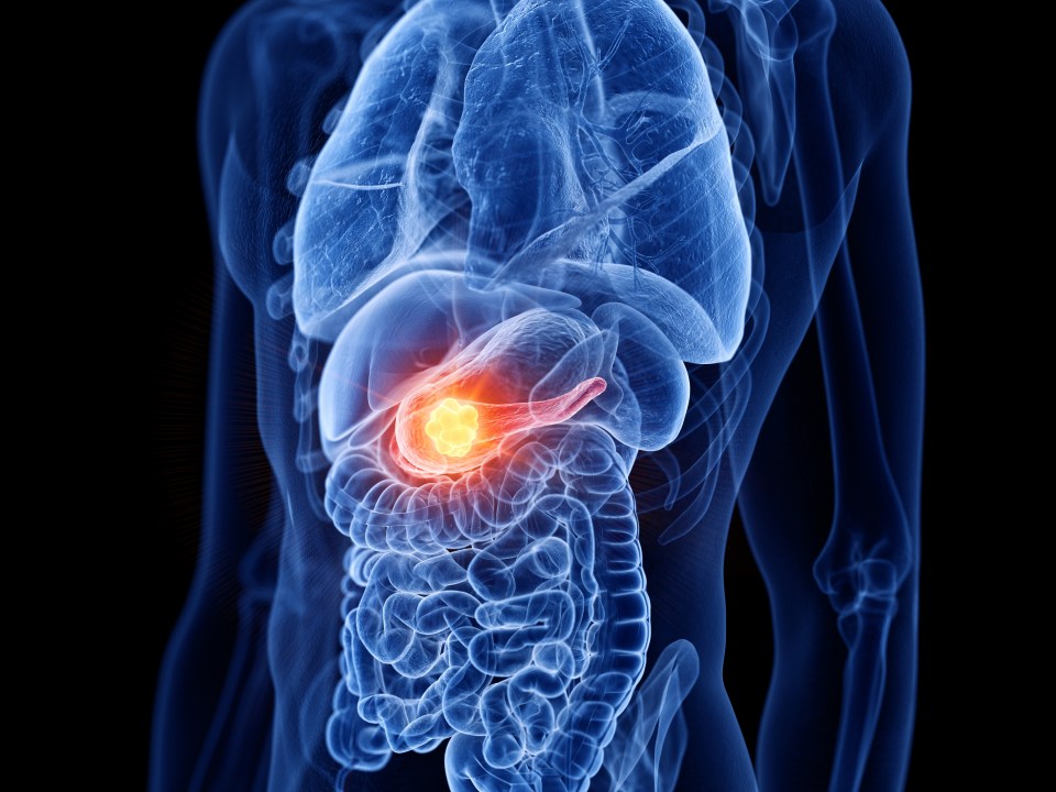 Illustration of pancreatic cancer.