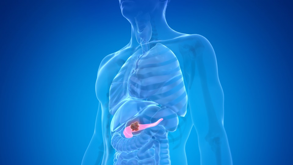 Illustration of pancreatic cancer.