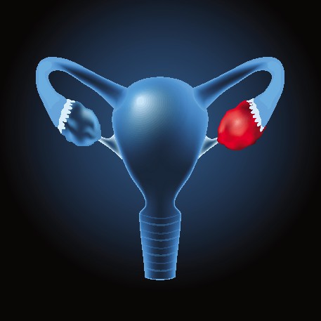 Illustration of a uterus with an ovarian cyst.
