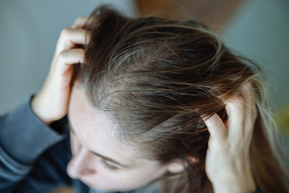 Woman scratching her head, showing signs of dandruff.