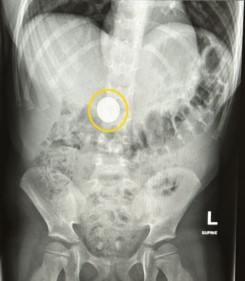 X-ray showing a button battery swallowed by a child.