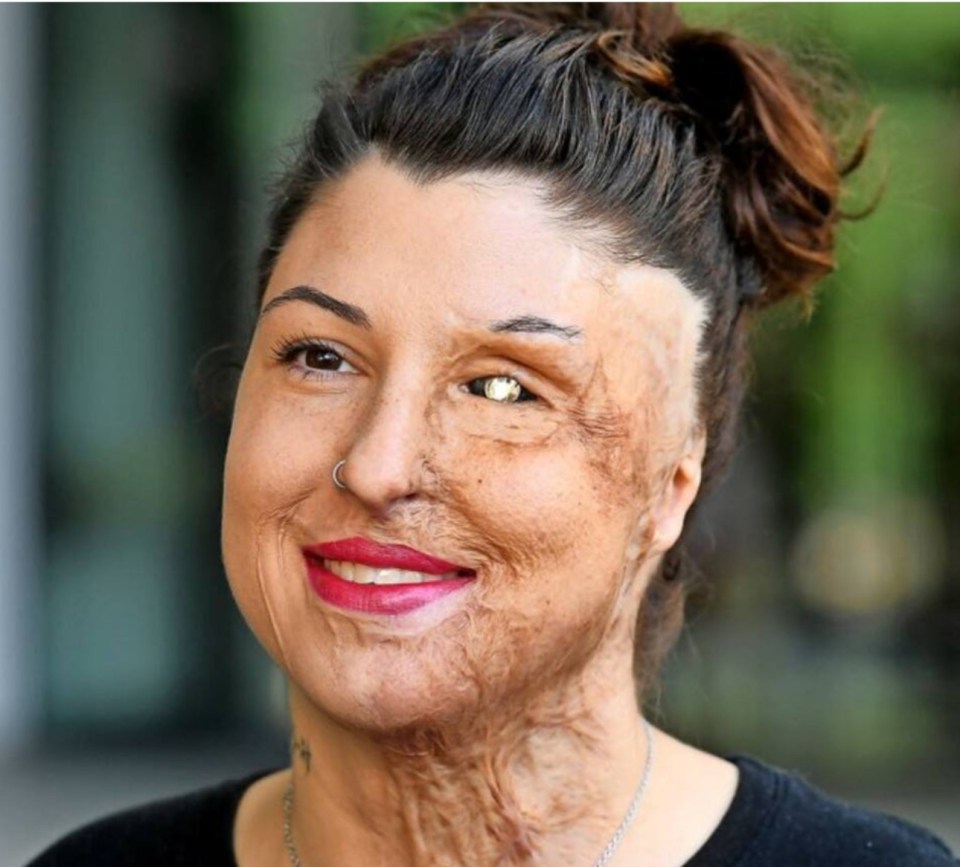 Portrait of Vanessa Münstermann, a victim of an acid attack.