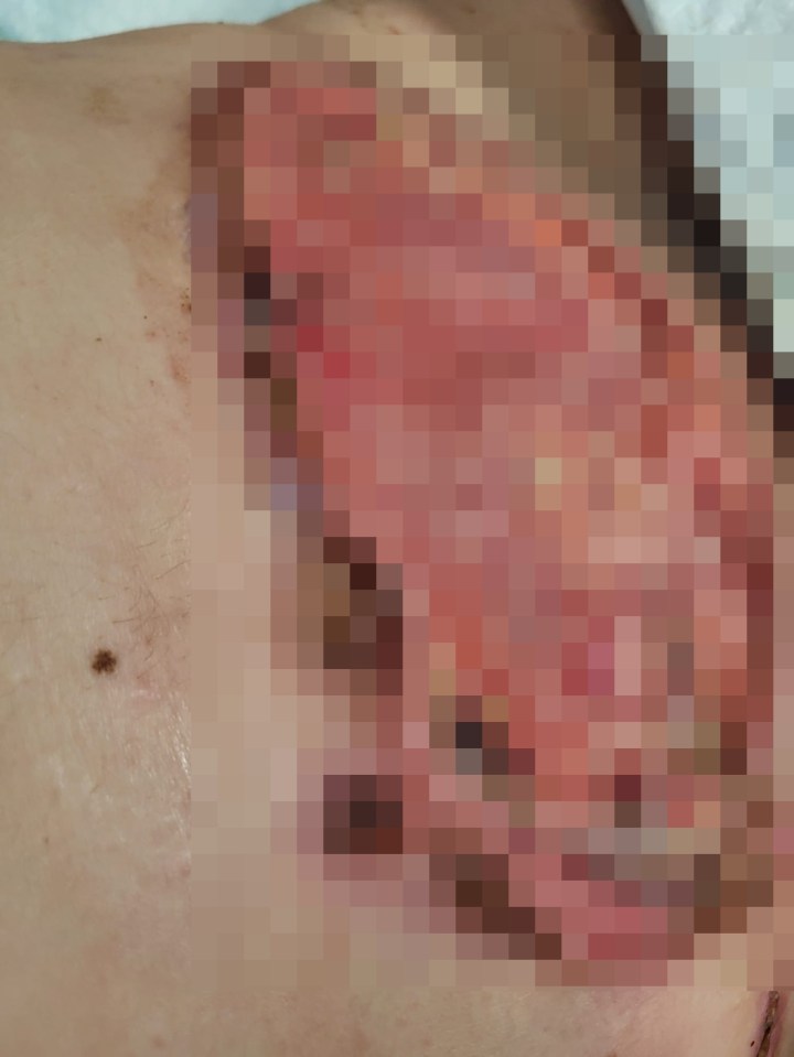 Infection after a botched tummy tuck procedure.