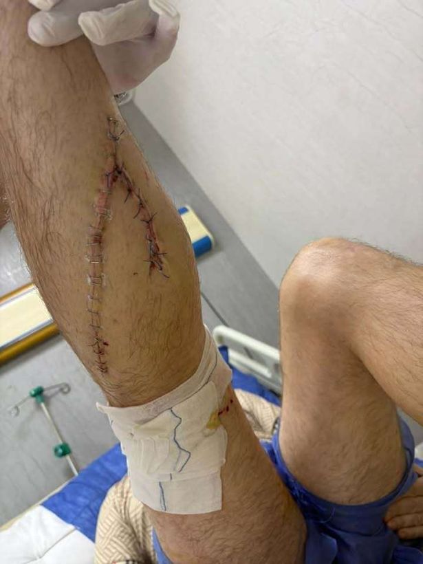 Kaylum's leg (Cover Images)