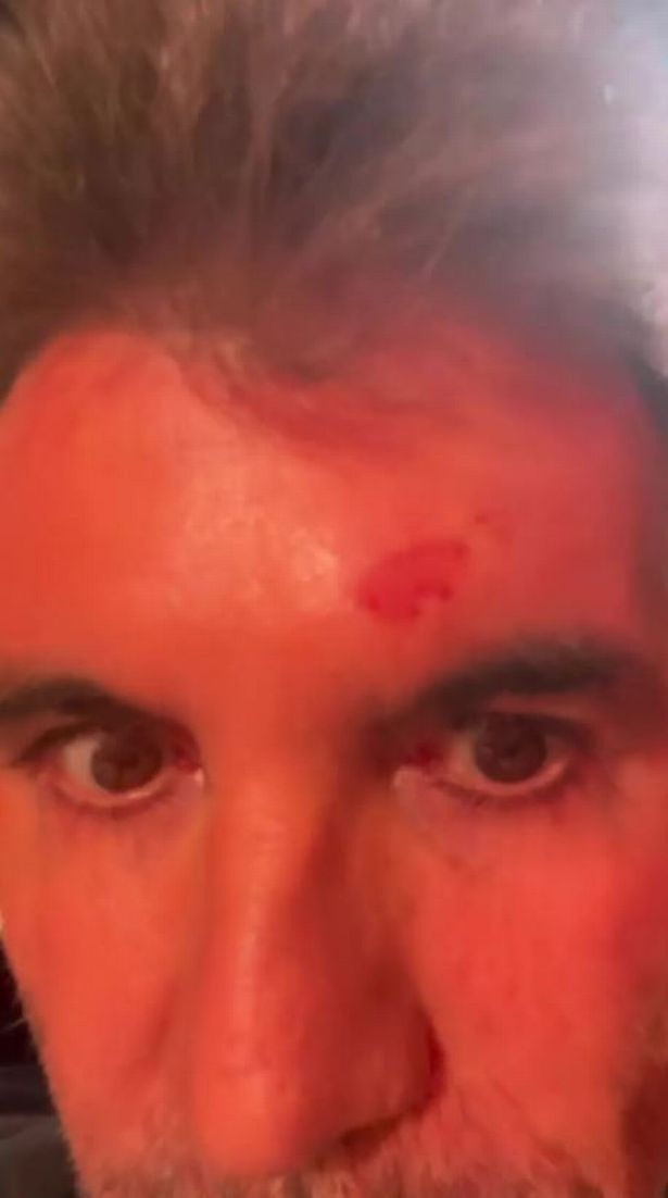 Simon Cowell was forced to drop out of BGT filming