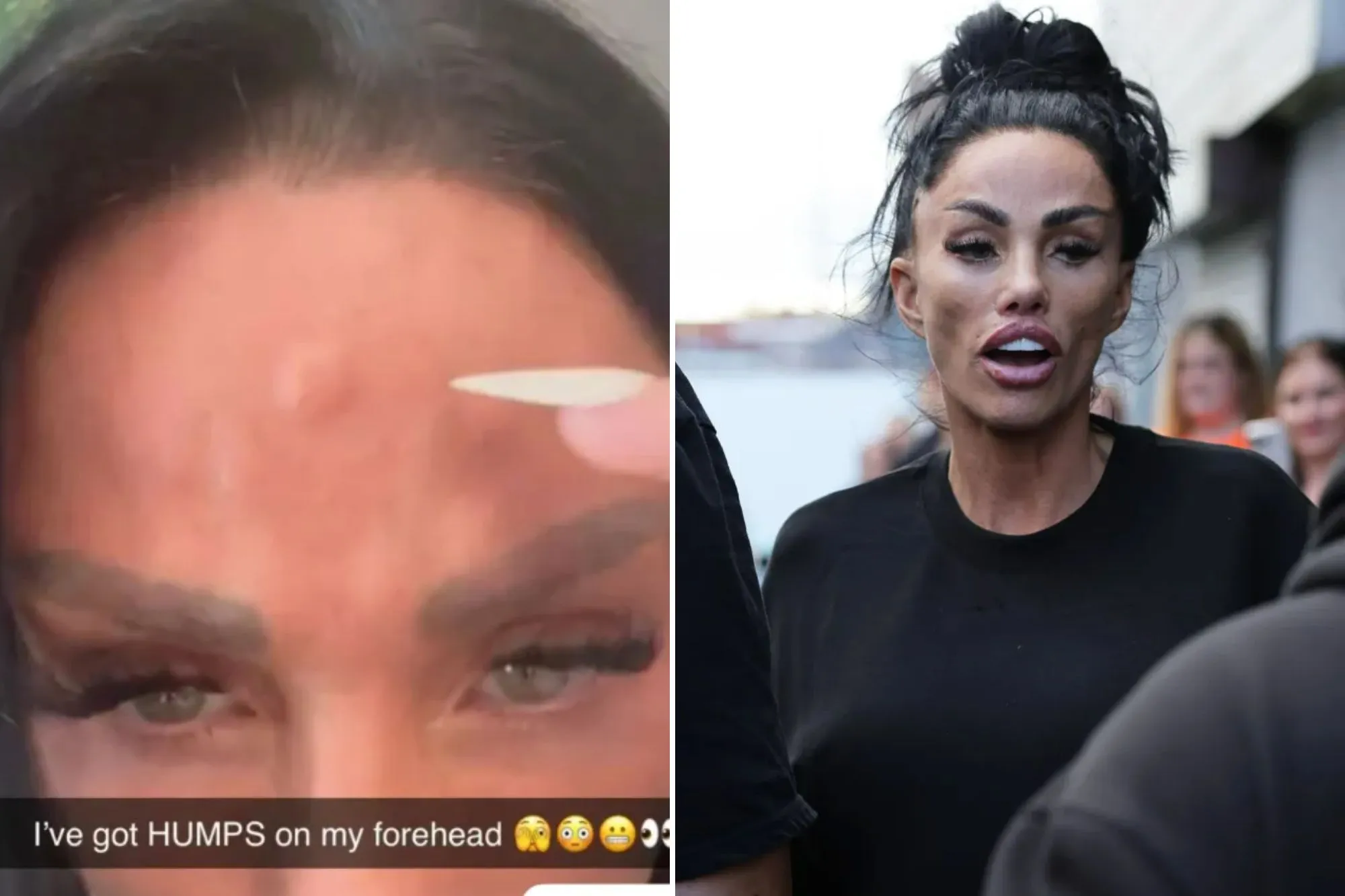 An image collage containing 2 images, Image 1 shows Katie Price with a visible lump on her forehead, Image 2 shows Katie Price arriving at the Theatre Royal St Helens